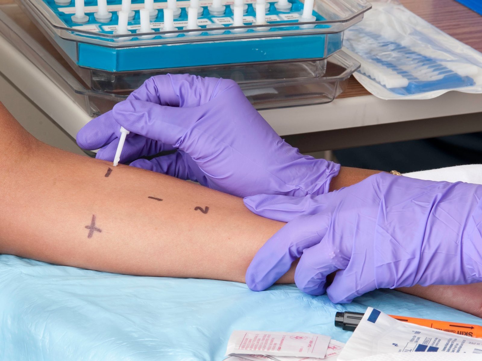 Skin prick test being done on the forearm at an allergy clinic