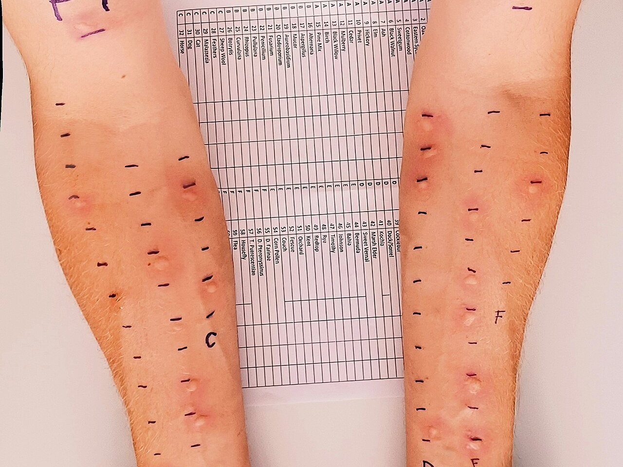 Skin prick test result on both forearms showing raised wheals next to marked allergen sites